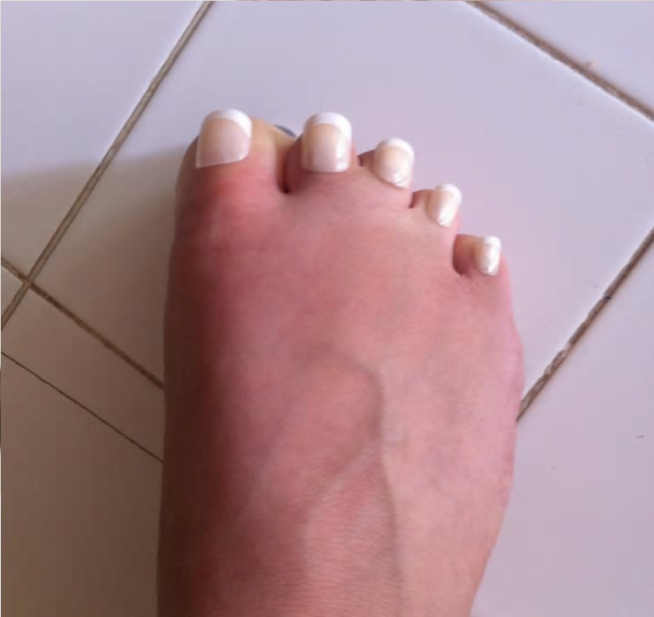 u&ntilde;as de los pies raras
